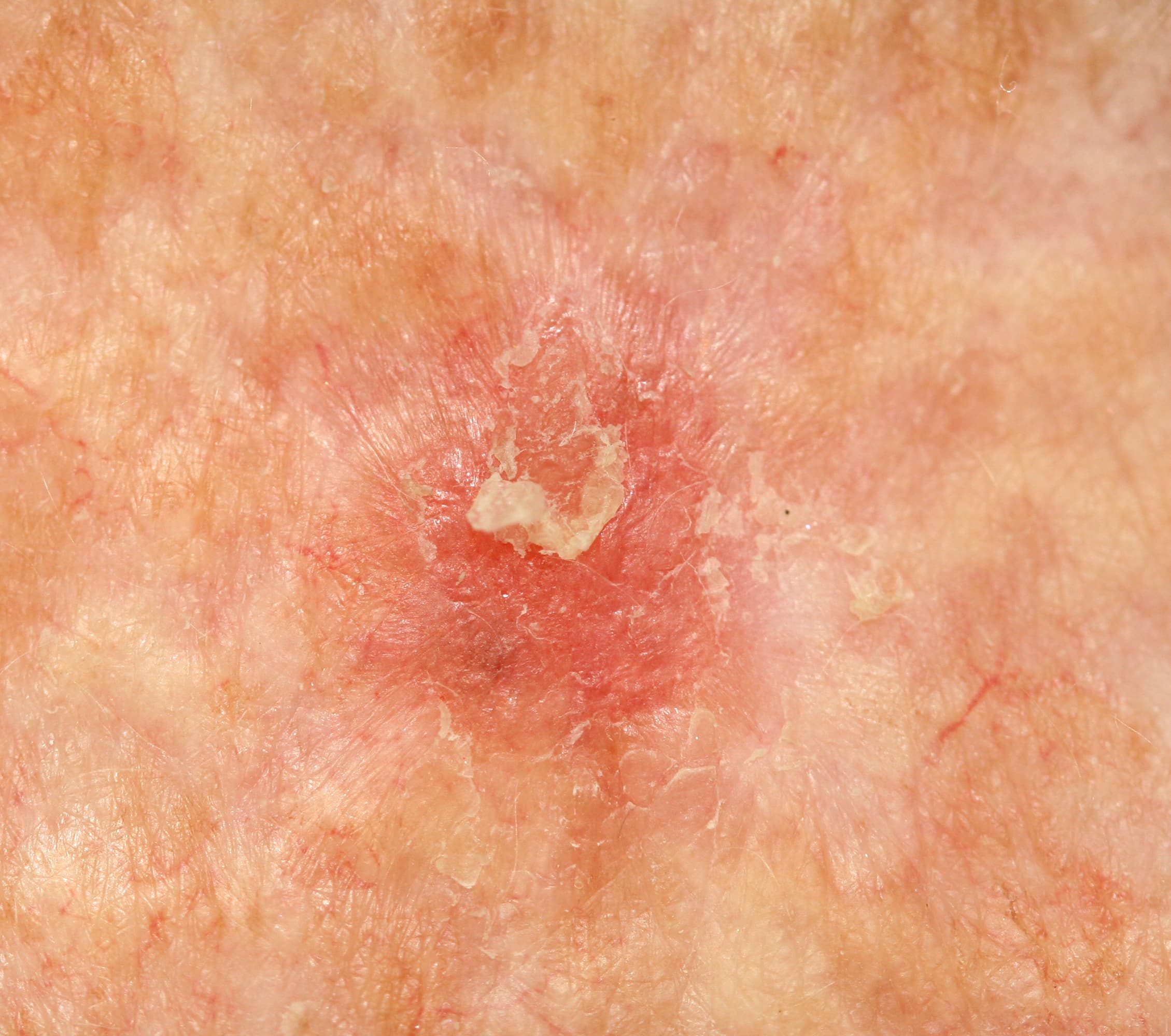 Actinic Keratosis Study