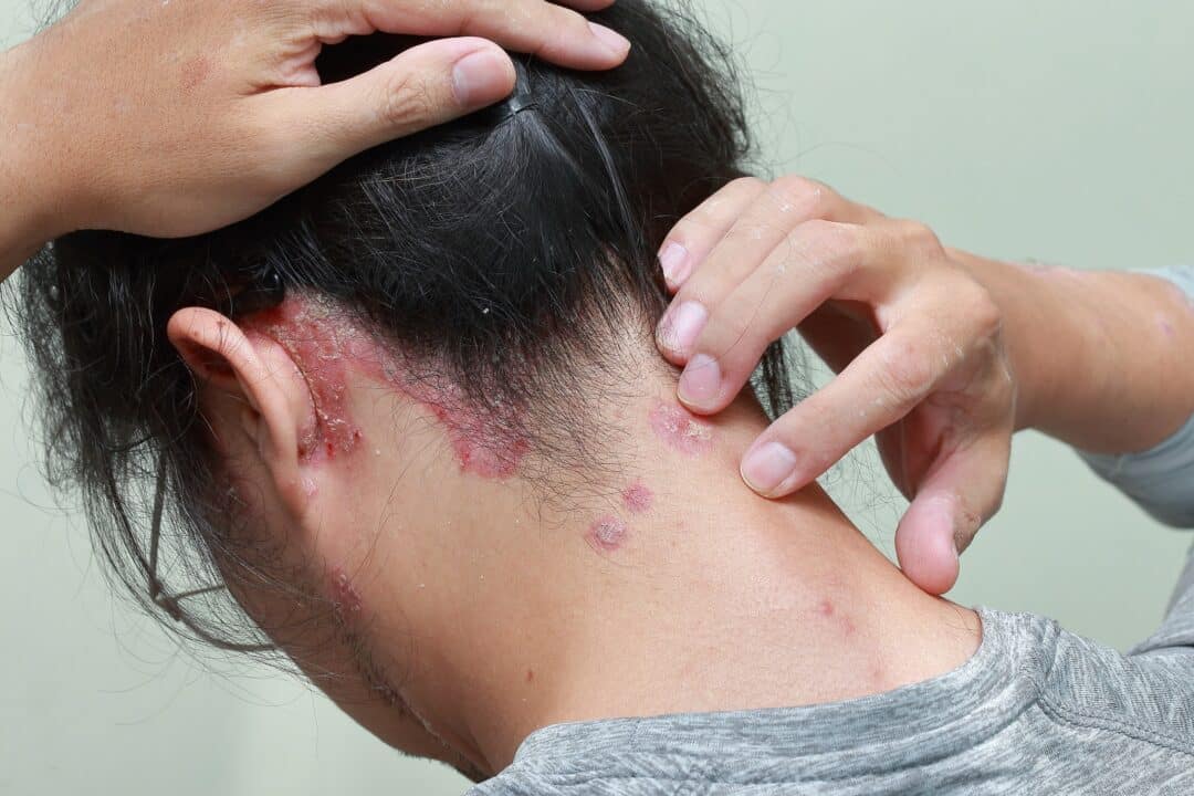 Scalp Psoriasis Study