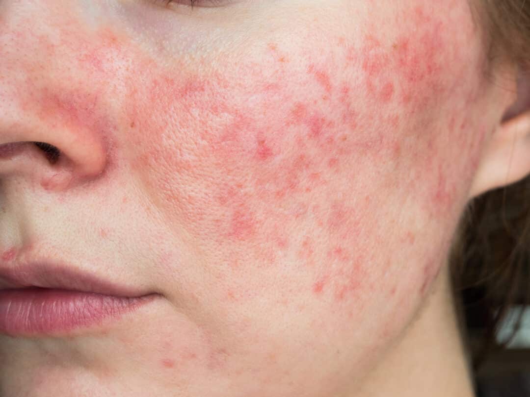 Rosacea Study