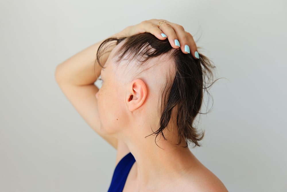 Alopecia Areata study