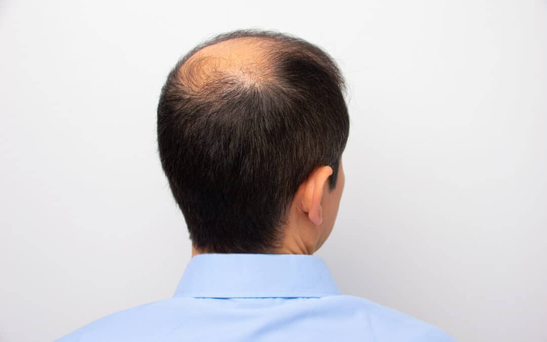 Men’s Hair Loss