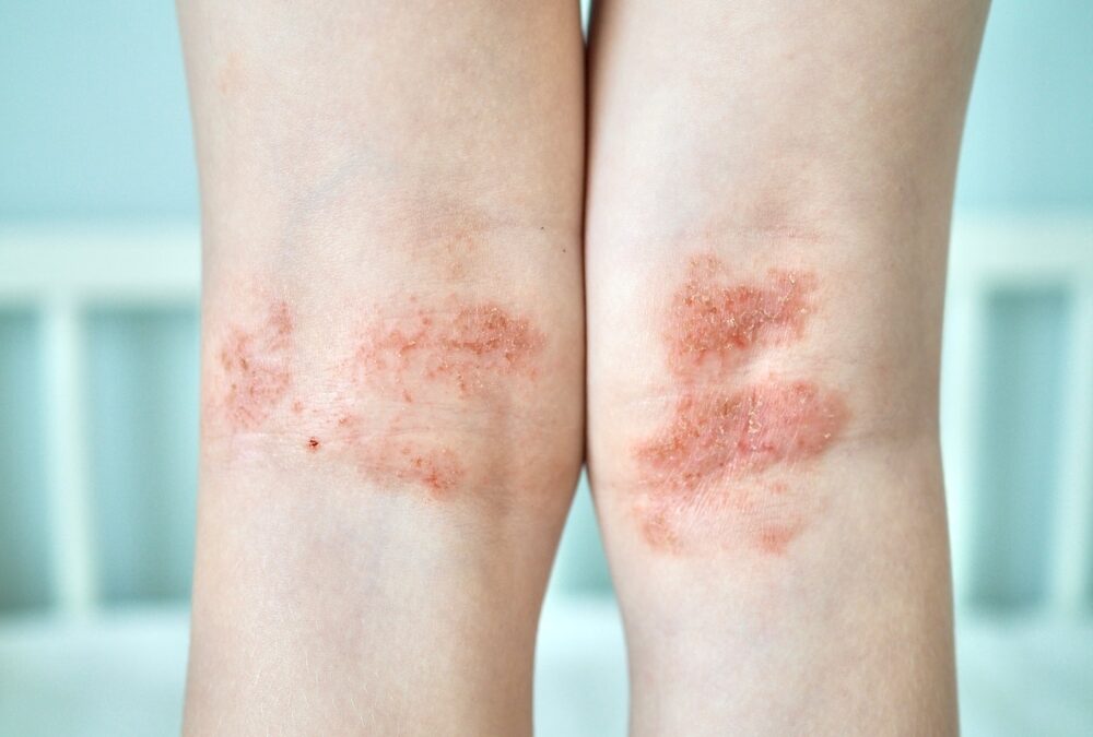 Eczema,On,Kid’s,Legs.,Atopic,Dermatitis,Close,Up.,Allergy,Spots